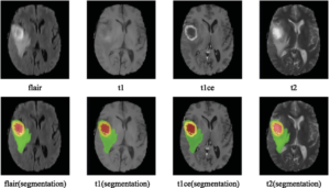 Brain MRI Image Segmentation Tumor Detection Project PPT 1 Free Download